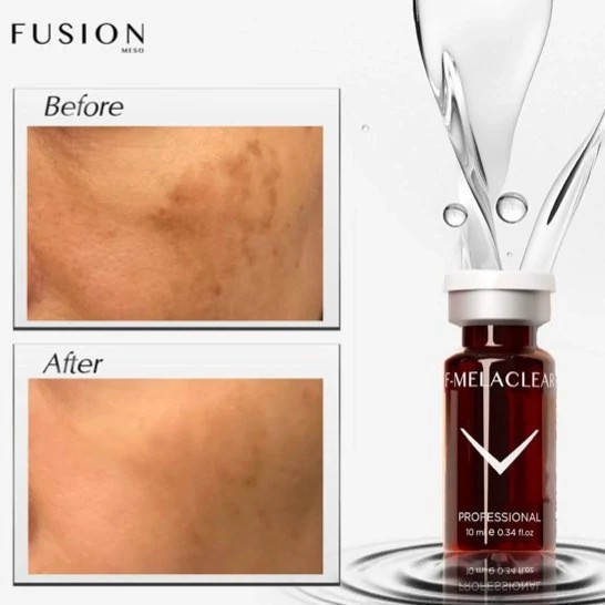 مزوکوکتل رفع لکه پوست با اثر قوی فیوژن F-MELACLEAR 10 سی سی